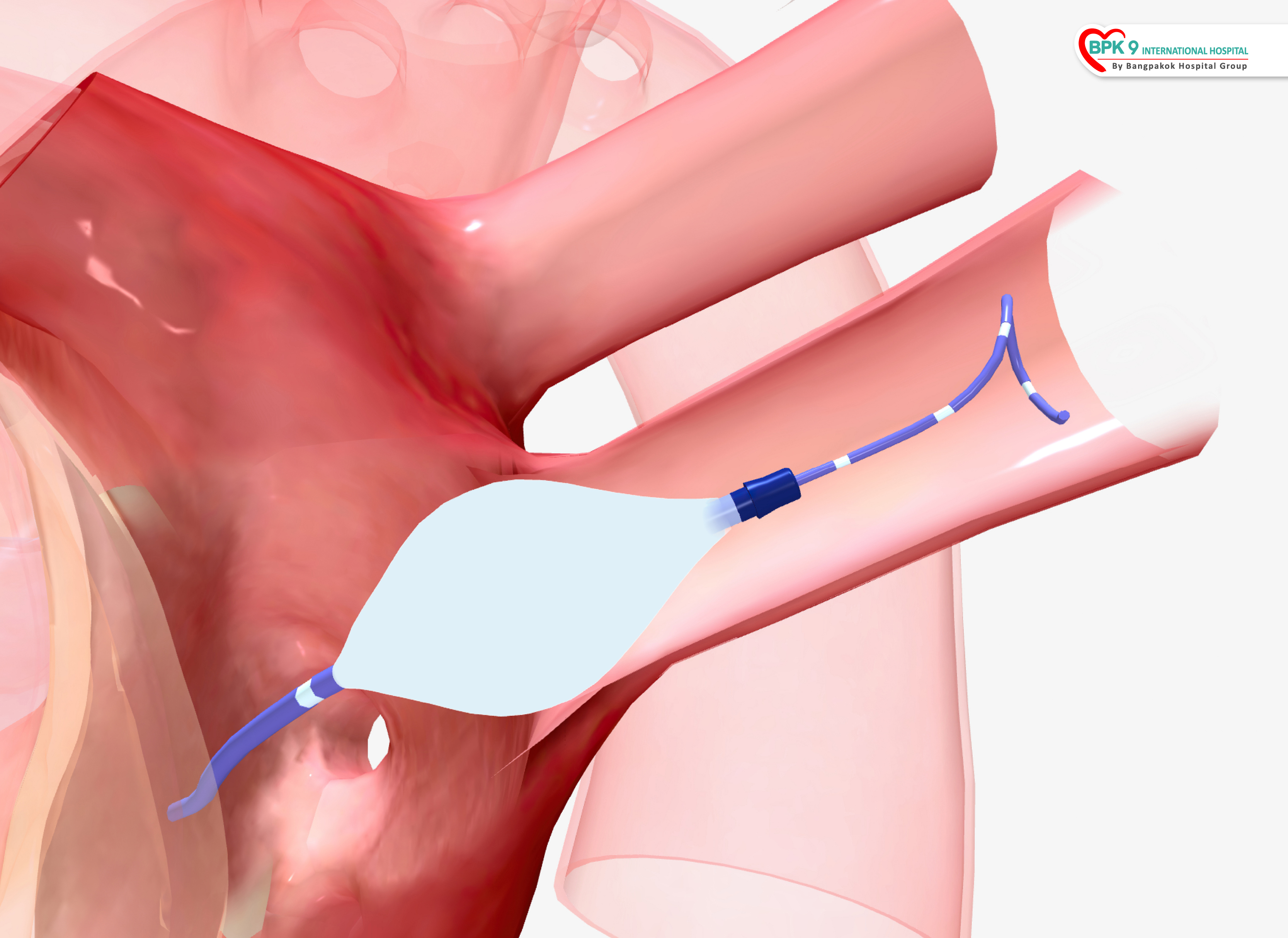 Cardiac Cryoablation